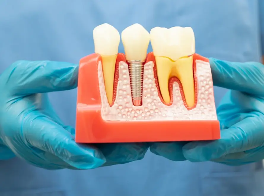 diş implantı