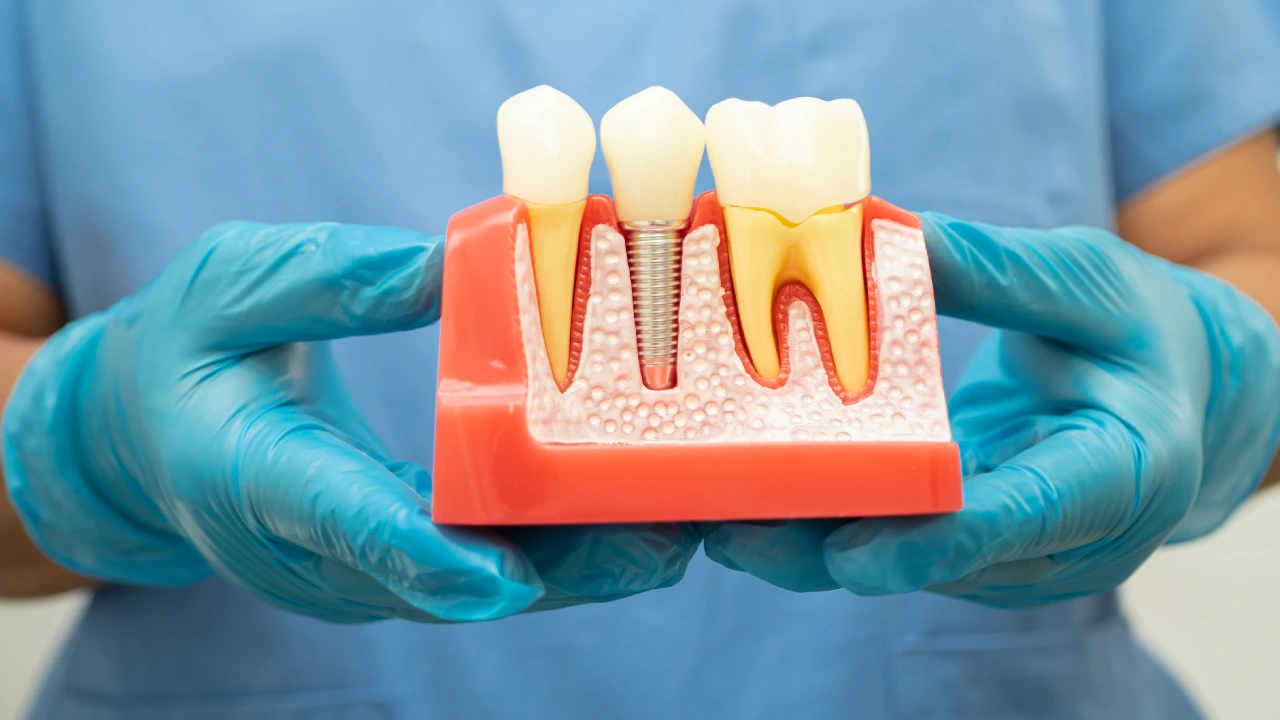 diş implantı